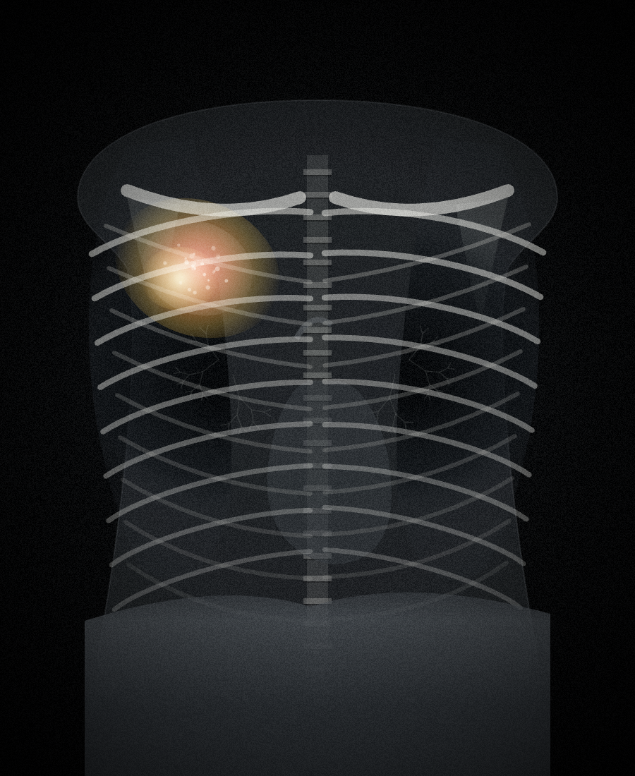 Chest X-ray heatmap preview